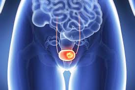 Nasce la Bladder Cancer Policy Alliance: un'alleanza europea per migliorare la cura del tumore alla vescica